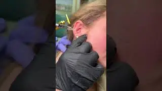 Botox Magic For Face Shaping and Tooth Grinding !