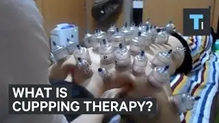 What is cupping therapy?