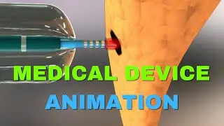 Accessor Medical - Medical Device Animation | Austin Visuals