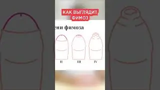 🔴 Как выглядит Фимоз у детей фото. Симптомы фимоза у мальчиков, не открывается головка