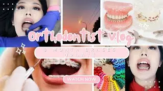 BRACES VLOG EP.5: 3 MONTH BRACES UPDATE + GOOD NEWS!?, wire changed, braces color, power chain