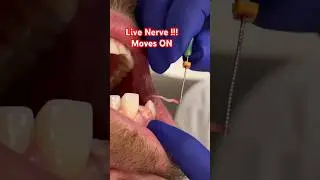 Live NERVES 😳!! Root Canal
