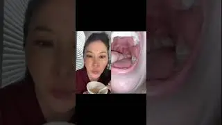 Dentist reacts to huge juicy tonsil stones 