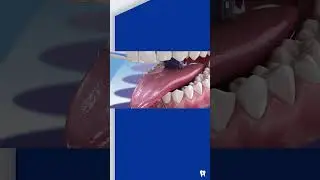 ¿Cómo se previene la formación de SARRO DENTAL? 