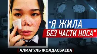 Пластырь вместо части носа. Буллинг, операции и новая жизнь.