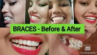 BRACES - Before & After/ Braces 15 months journey/ Braces Time lapse #braces #trending #viral #yt
