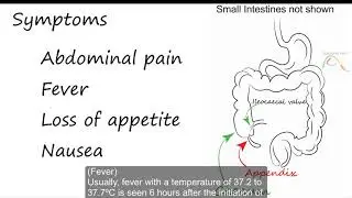 Acute Appendicitis - with captions
