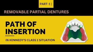 Understanding Path of Insertion in Kennedy's Class 1 Situations | Dental Prosthetics Guide