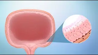 Treatment for Bladder Cancer