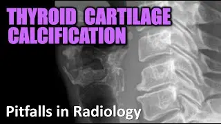 Thyroid Cartilage Calcification - Pitfalls in Radiology #radiology #xray