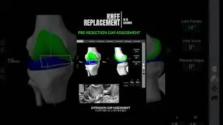 Robotic Knee Replacement 🤖 in 15 seconds #shorts #kneereplacementsurgeon