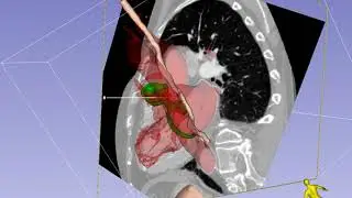 Mid-Esophageal Long-Axis Imaging Plane in TEE - En Face View