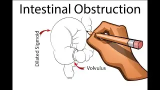 Intestinal Obstruction -  Part 1