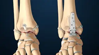 Arthrodesis | Anterior Ankle Fusion Surgery | Nucleus Health