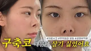 병원 잘못 선택하면 코가 망하는 이유 | 말도 없이 의사가 세번이나 바뀜🤬 | 코수술 망한 썰, 수술 당일~1개월 차까지
