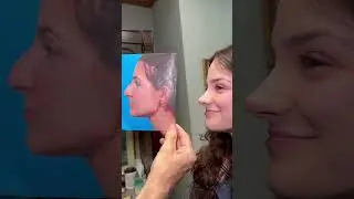 Long-term Results Matter in Rhinoplasty