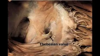 Thebesian valve