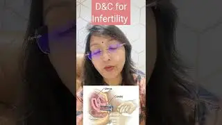 क्या बच्चेदानी की सफाई कराने से गर्भ जल्दी ठहर जाता है  D&C for infertility