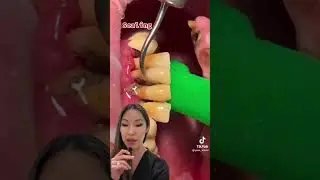 Loose Teeth Bone Loss 