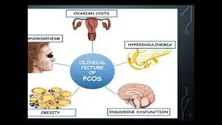Pathophysiology of Polycystic Ovarian Syndrome