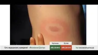 Аллергия на укус клеща