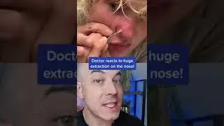 Doctor reacts to massive nose pimple extraction! 