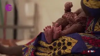 One Million Mpox Vaccines Secured for 13 African Countries