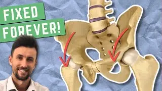 How to Permanently Fix an Anterior Pelvic Tilt