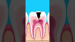 What happens if tooth decay is left untreated