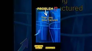 Thigh Femur Bone Fracture 🔥 हड्डी का हो गया काम 💥 