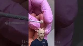 Freezing warts off EXPLAINED 🥶🥶🥶 #dermatology #dermreacts #wartstreatment #freezing