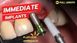 Extraction and Immediate Placement (Flapless)