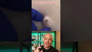 Derm reacts to HUGE pore! 