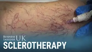 This simple procedure makes varicose veins disappear