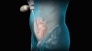 Total Extraperitoneal (TEP) Laparoscopic Inguinal Hernia Repair | Nucleus Health