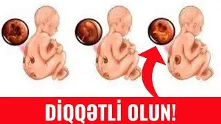 Uşaqlarda Böyrək Genişlənməsi- SƏBƏBLƏRİ...