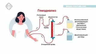 Гемодиализ.