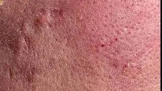 Remoção de cravo 2021 - Pimple Popping 2021 -Blackhead Removal  EP007