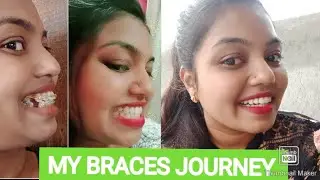 MY BRACES JOURNEY #braces #bracesjourney #orthodontics #timelapse #transformationvideo #trending