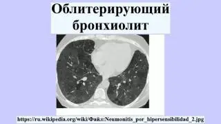 Облитерирующий бронхиолит