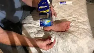 How to remove a plantar wart at home, Compound W freeze off wart removal system used on my foot