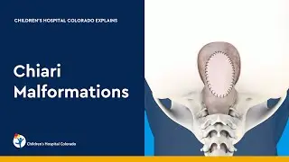 Chiari Malformation and Treatment