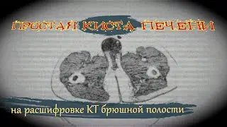 Простая КИСТА ПЕЧЕНИ и ПЕРЕГИБ желчного пузыря на РАСШИФРОВКЕ КТ брюшной полости (второе мнение КТ)