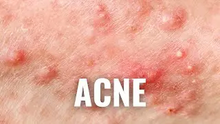 8 Things To Avoid If You Have ACNE