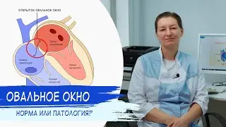 ОТКРЫТОЕ ОВАЛЬНОЕ ОКНО | Норма или патология?