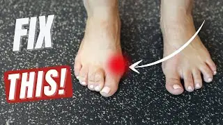 How to Fix Your Bunions