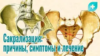 Сакрализация: причины, симптомы и лечение