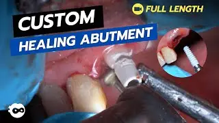 Immediate Implant with Custom Healing Abutment