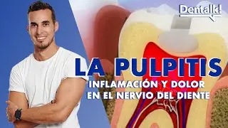 ¿Dolor de MUELAS? Podría ser PULPITIS - Tratamiento INFLAMACIÓN NERVIO dental | Dentalk! ©