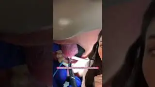 Tongue tie release. How they do it. 